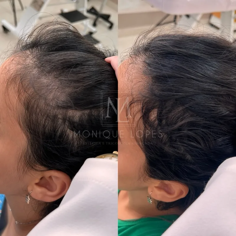 Tratamento de rarefação capilar e calvície antes e depois - Dra. Monique Lopes Passos MG