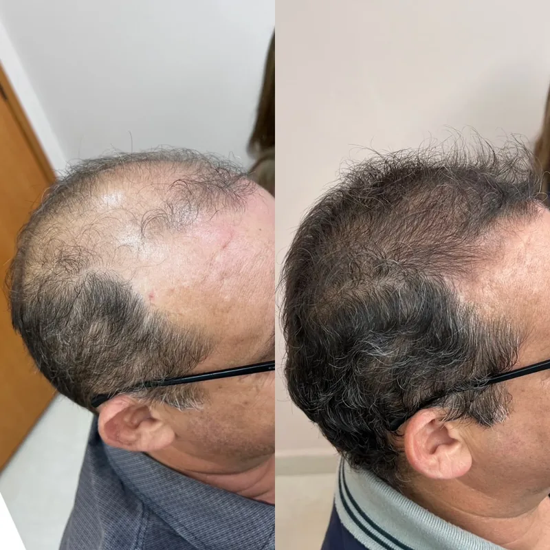 Resultado expressivo em calvície avançada masculina antes e depois - Dra. Monique Lopes Passos MG