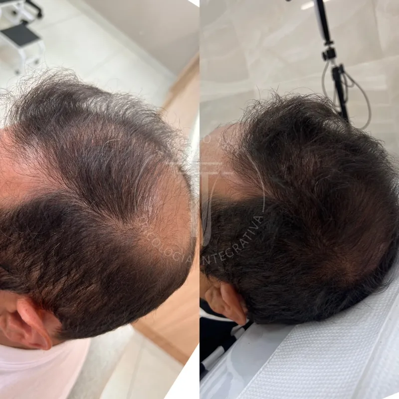 Evolução do tratamento de rarefação na coroa e alopecia capilar antes e depois - Dra. Monique Lopes Passos MG