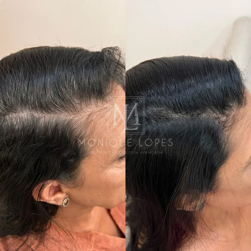 Preenchimento de falhas no topo da cabeça e coroa capilar - Dra. Monique Lopes Passos MG