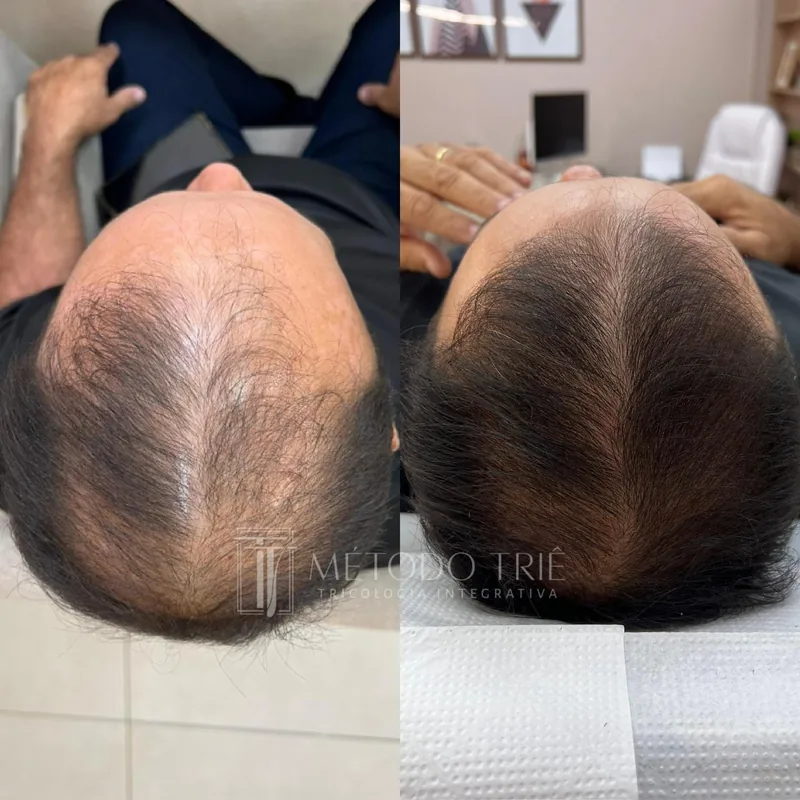 Resultado de tratamento para queda capilar antes e depois - Dra. Monique Lopes Passos MG