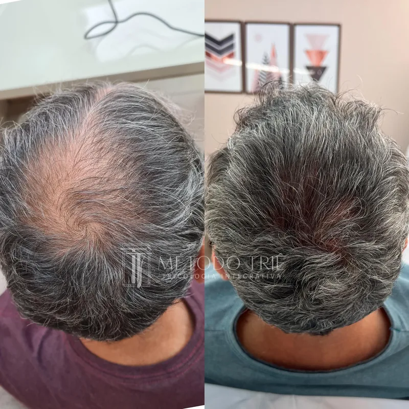 Recuperação e aumento de densidade capilar antes e depois - Dra. Monique Lopes Passos MG