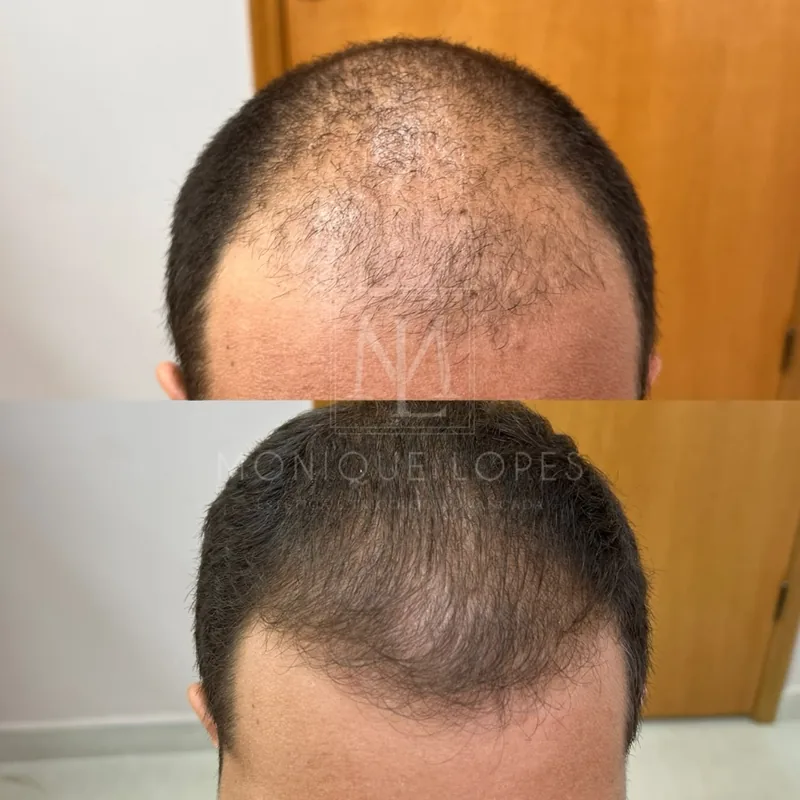 Recuperação de linha frontal e novos fios antes e depois - Dra. Monique Lopes Passos MG
