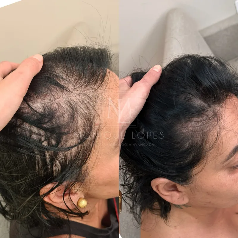 Resultado de protocolo integrativo para saúde capilar - Dra. Monique Lopes Passos MG