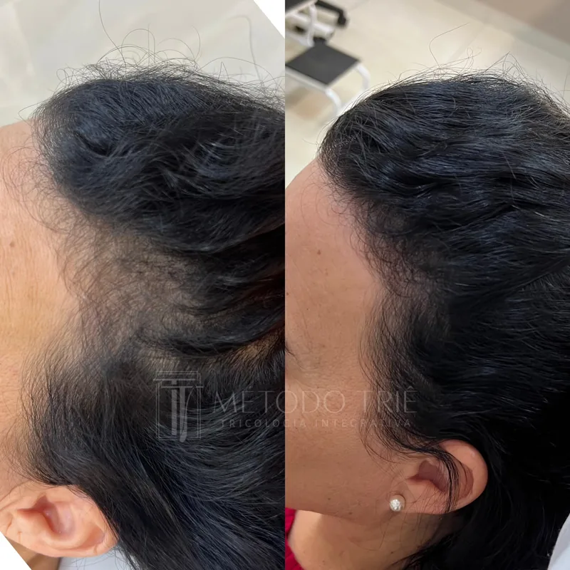 Tratamento personalizado de tricologia avançada antes e depois - Dra. Monique Lopes Passos MG